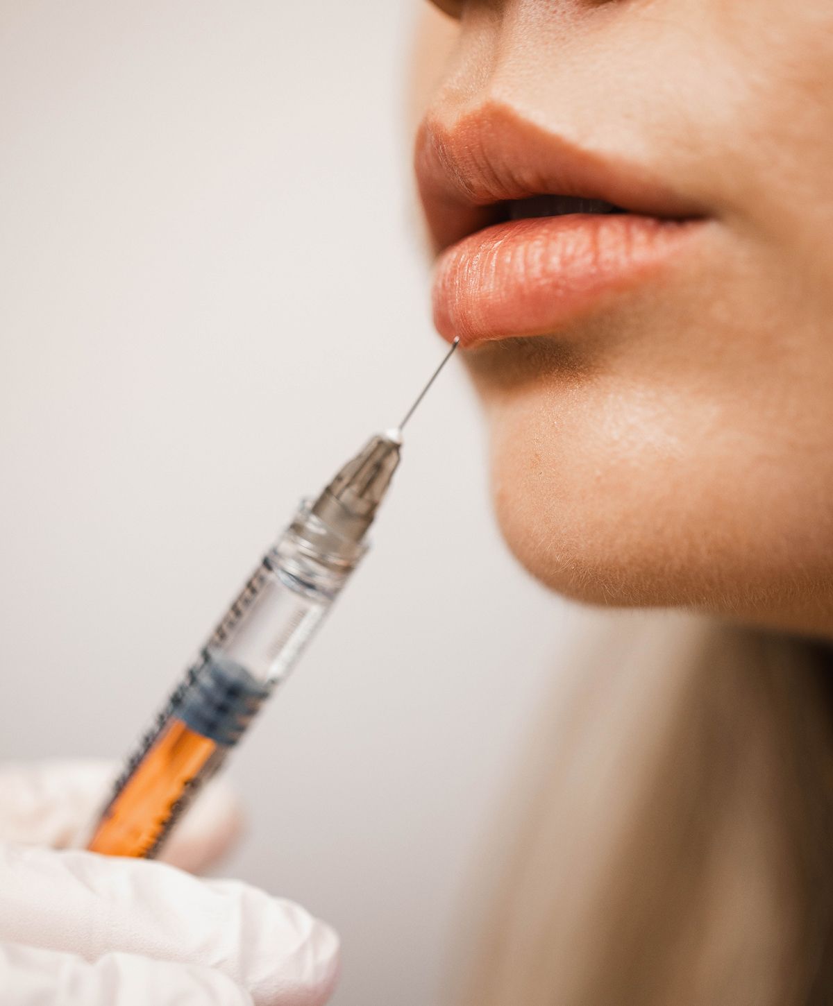 Lip injection procedure with syringe and needle.