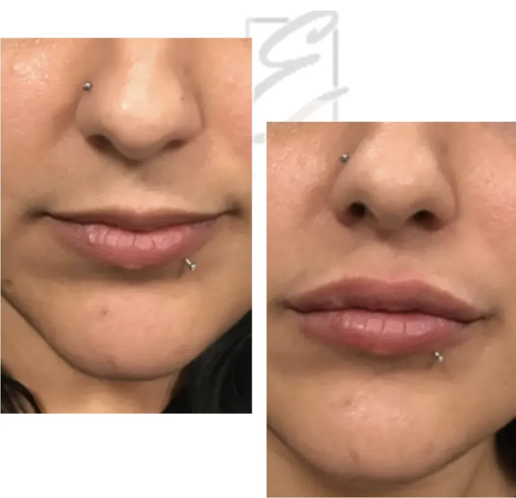 Before and after facial aesthetic treatment comparison.