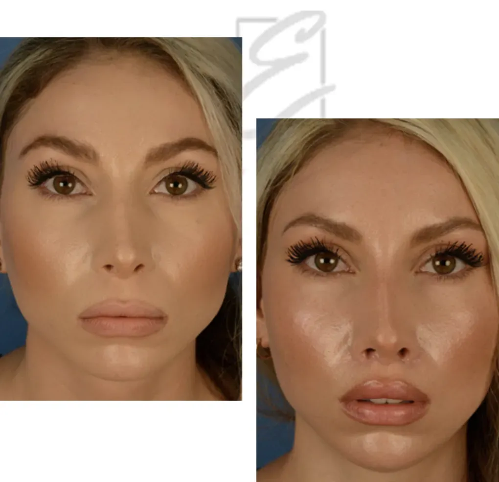 Before and after lip enhancement comparison photo.
