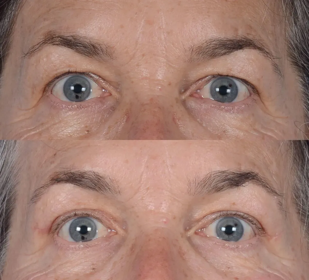 Upper Blepharoplasty Before & After