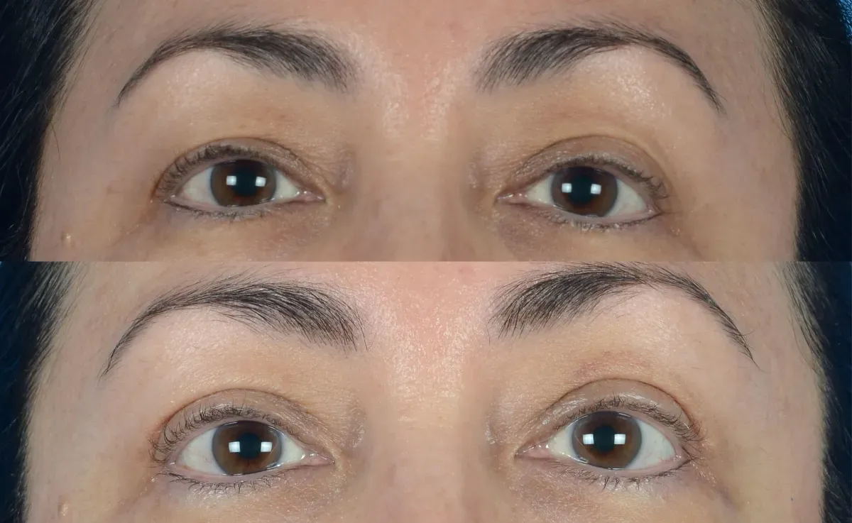 Upper Blepharoplasty Before & After