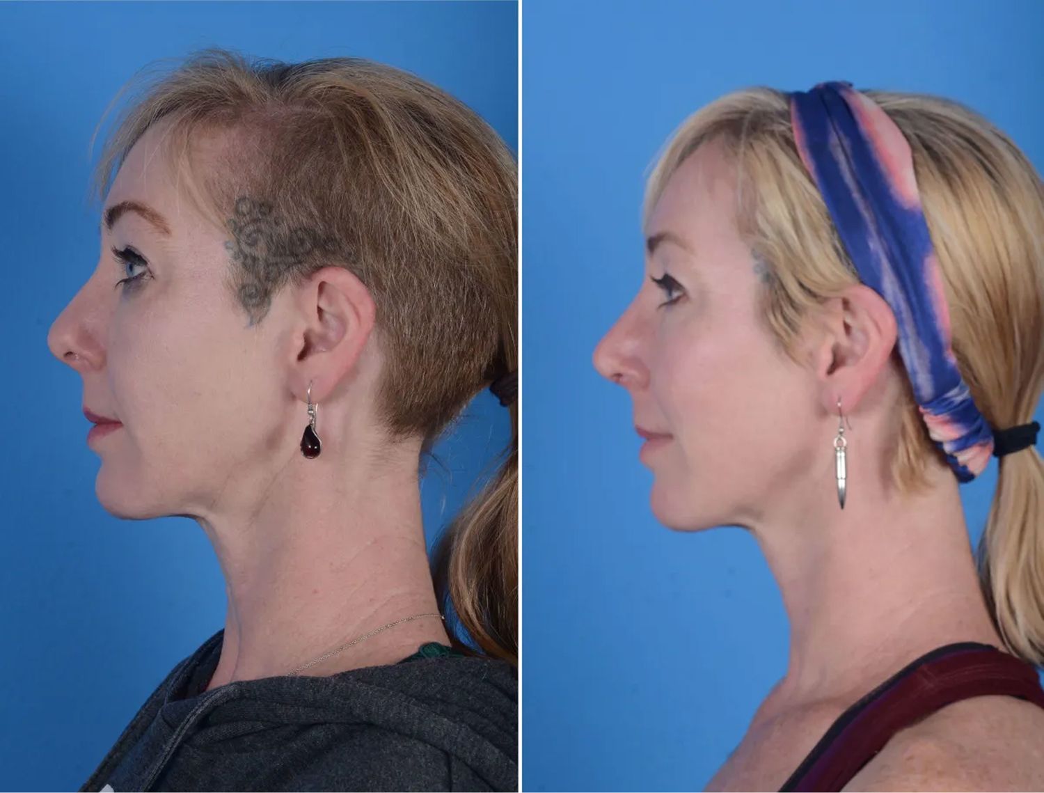 Rhinoplasty Before & After